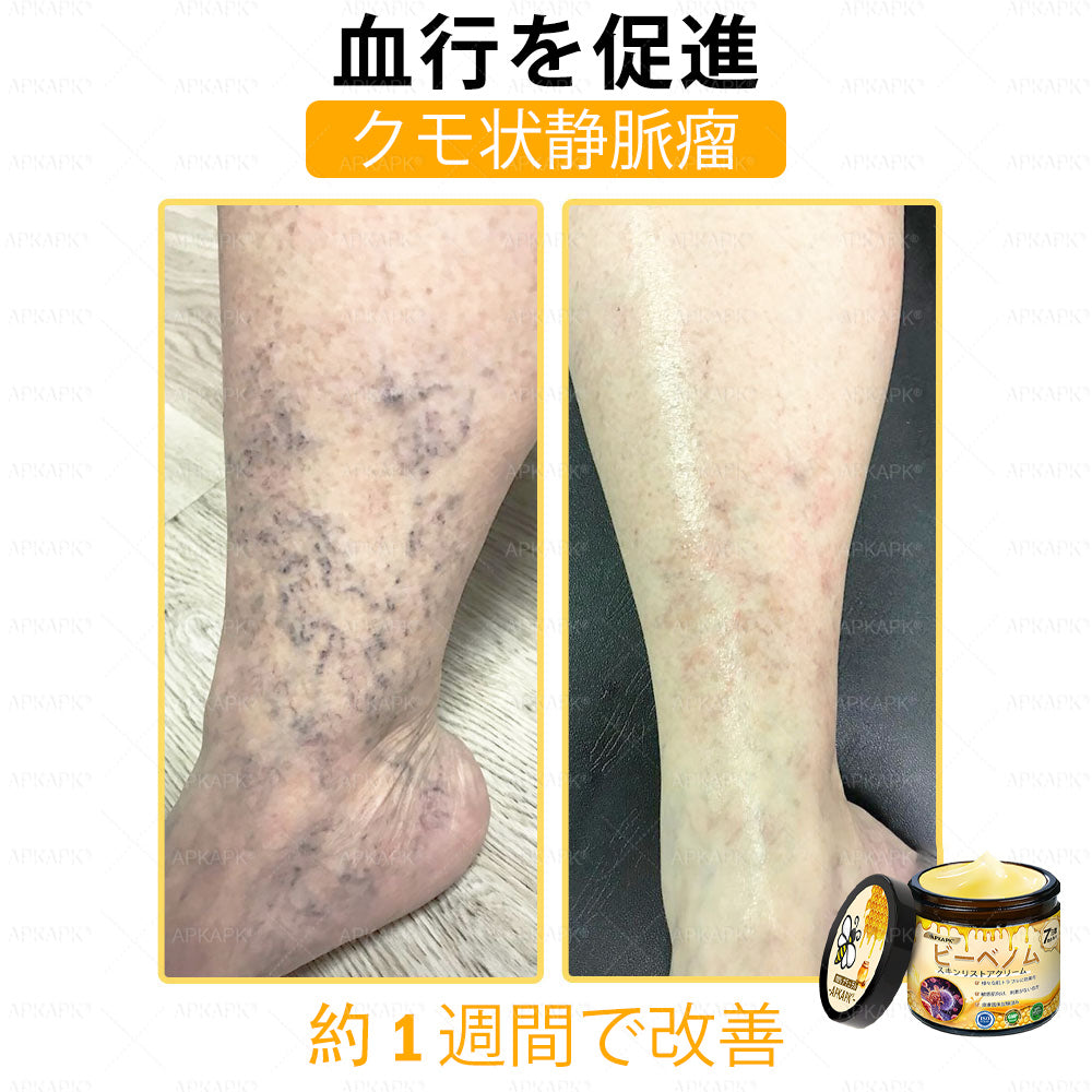 ✨✨APKAPK® 𝗠É𝗛𝗠É𝗥𝗘𝗚 総合クリーム🥇 皮膚の隆起に対するケアには以下が含まれます： 加齢によるシミ、傷跡、いぼ、皮膚の隆起、脂肪の塊、ニキビ、湿疹、乾癬、反転性ニキビ、しわ、皮膚の老化およびその他の問題🔥