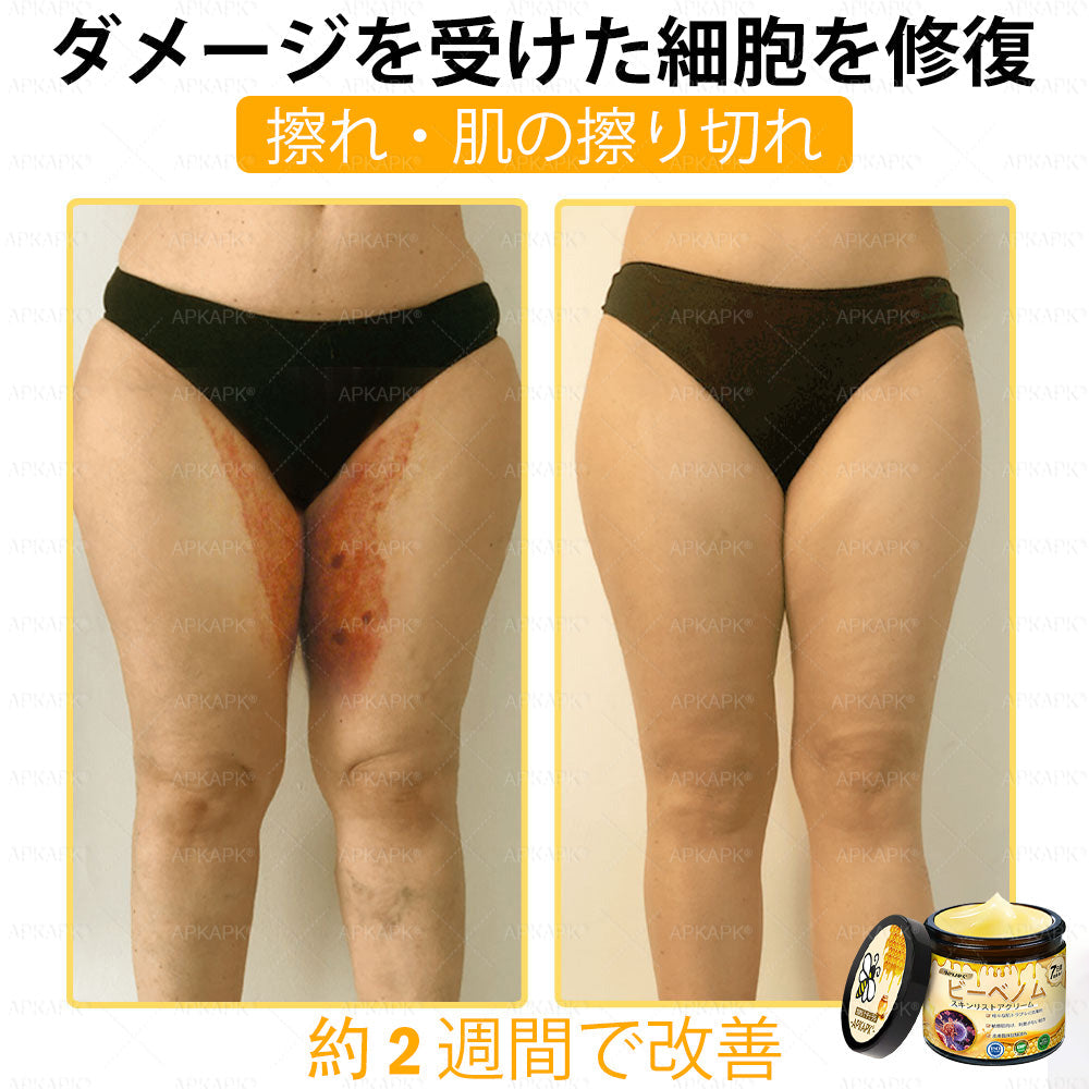 ✨✨APKAPK® 𝗠É𝗛𝗠É𝗥𝗘𝗚 総合クリーム🥇 皮膚の隆起に対するケアには以下が含まれます： 加齢によるシミ、傷跡、いぼ、皮膚の隆起、脂肪の塊、ニキビ、湿疹、乾癬、反転性ニキビ、しわ、皮膚の老化およびその他の問題🔥