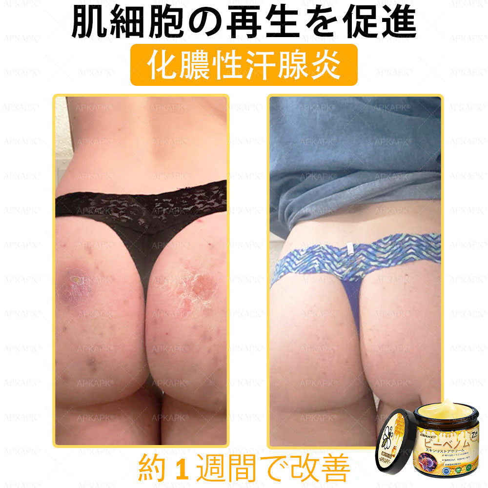 ✨✨APKAPK® 𝗠É𝗛𝗠É𝗥𝗘𝗚 総合クリーム🥇 皮膚の隆起に対するケアには以下が含まれます： 加齢によるシミ、傷跡、いぼ、皮膚の隆起、脂肪の塊、ニキビ、湿疹、乾癬、反転性ニキビ、しわ、皮膚の老化およびその他の問題🔥