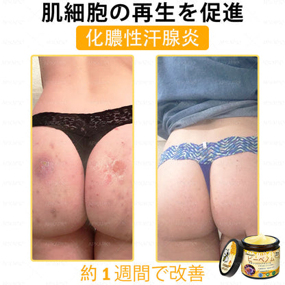 ✨✨APKAPK® 𝗠É𝗛𝗠É𝗥𝗘𝗚 総合クリーム🥇 皮膚の隆起に対するケアには以下が含まれます： 加齢によるシミ、傷跡、いぼ、皮膚の隆起、脂肪の塊、ニキビ、湿疹、乾癬、反転性ニキビ、しわ、皮膚の老化およびその他の問題🔥