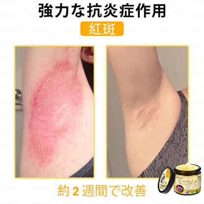 ✨✨APKAPK® 𝗠É𝗛𝗠É𝗥𝗘𝗚 総合クリーム🥇 皮膚の隆起に対するケアには以下が含まれます： 加齢によるシミ、傷跡、いぼ、皮膚の隆起、脂肪の塊、ニキビ、湿疹、乾癬、反転性ニキビ、しわ、皮膚の老化およびその他の問題🔥