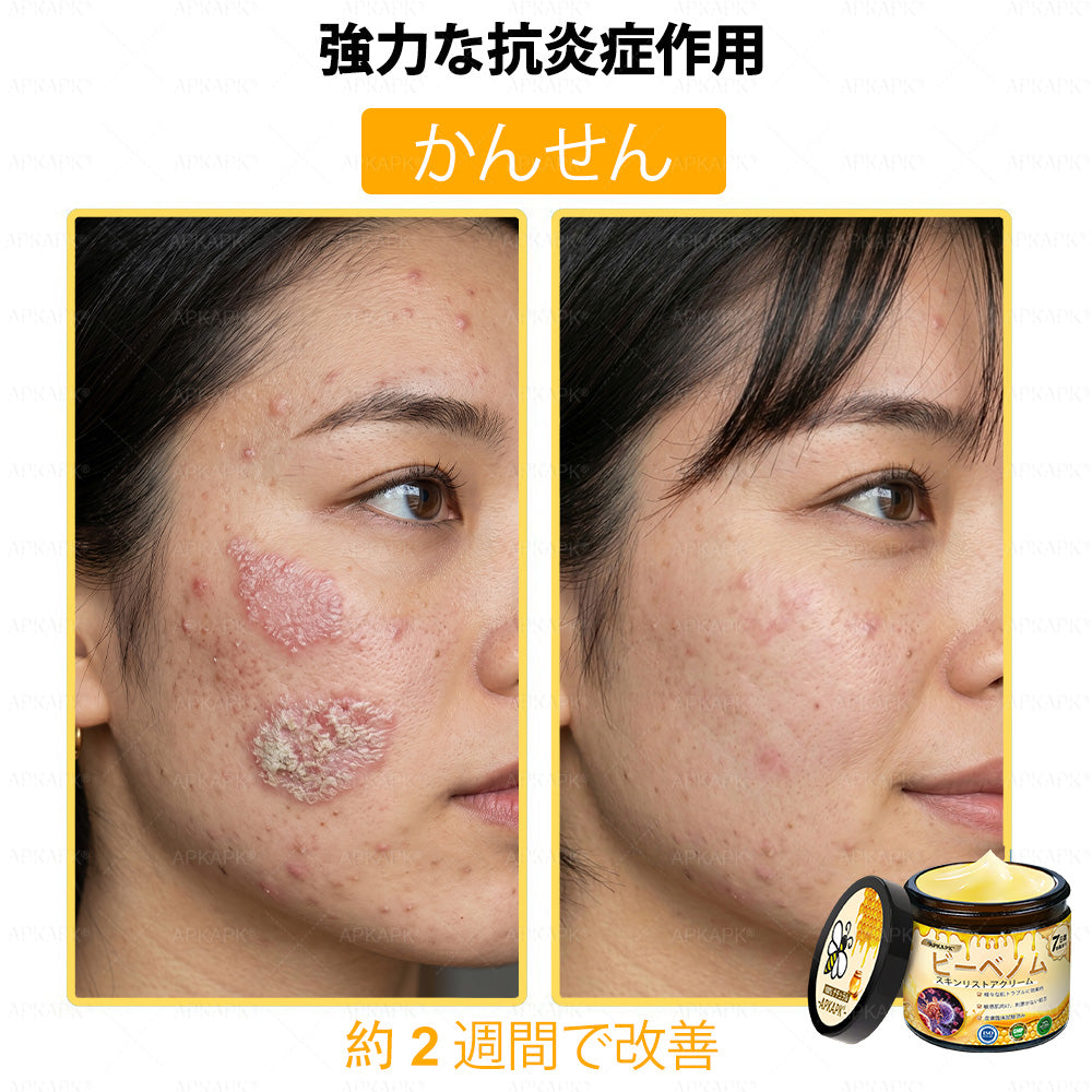 ✨✨APKAPK® 𝗠É𝗛𝗠É𝗥𝗘𝗚 総合クリーム🥇 皮膚の隆起に対するケアには以下が含まれます： 加齢によるシミ、傷跡、いぼ、皮膚の隆起、脂肪の塊、ニキビ、湿疹、乾癬、反転性ニキビ、しわ、皮膚の老化およびその他の問題🔥