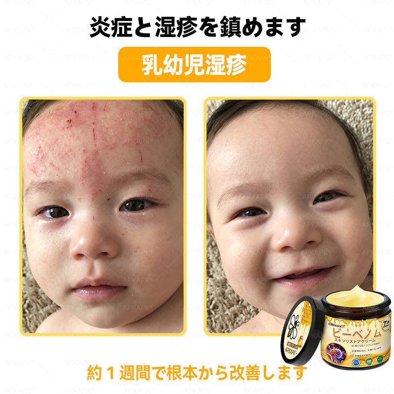 ✨✨APKAPK® 𝗠É𝗛𝗠É𝗥𝗘𝗚 総合クリーム🥇 皮膚の隆起に対するケアには以下が含まれます： 加齢によるシミ、傷跡、いぼ、皮膚の隆起、脂肪の塊、ニキビ、湿疹、乾癬、反転性ニキビ、しわ、皮膚の老化およびその他の問題🔥