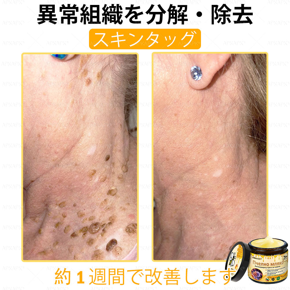 ✨✨APKAPK® 𝗠É𝗛𝗠É𝗥𝗘𝗚 総合クリーム🥇 皮膚の隆起に対するケアには以下が含まれます： 加齢によるシミ、傷跡、いぼ、皮膚の隆起、脂肪の塊、ニキビ、湿疹、乾癬、反転性ニキビ、しわ、皮膚の老化およびその他の問題🔥