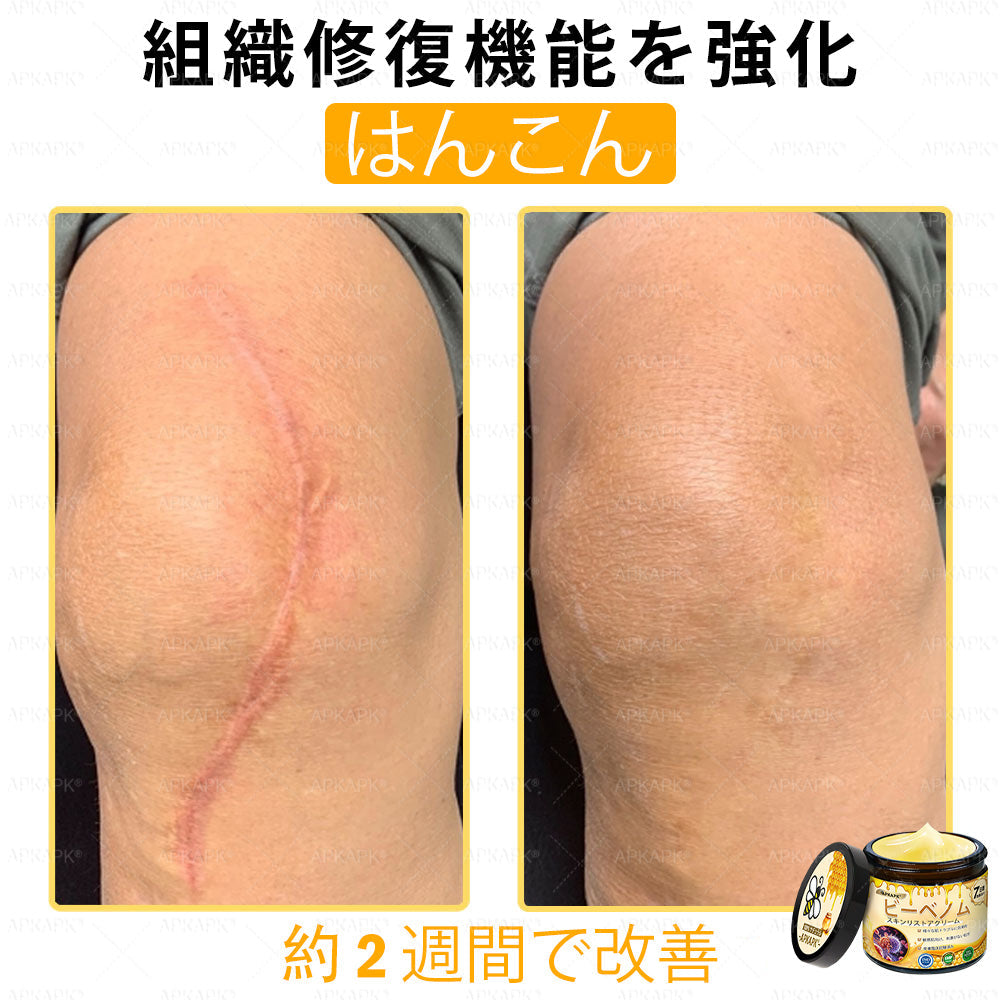 ✨✨APKAPK® 𝗠É𝗛𝗠É𝗥𝗘𝗚 総合クリーム🥇 皮膚の隆起に対するケアには以下が含まれます： 加齢によるシミ、傷跡、いぼ、皮膚の隆起、脂肪の塊、ニキビ、湿疹、乾癬、反転性ニキビ、しわ、皮膚の老化およびその他の問題🔥